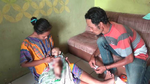 Tak Punya Biaya, Bayi dengan Usus Terburai Terpaksa Dirawat di Rumah Sendiri