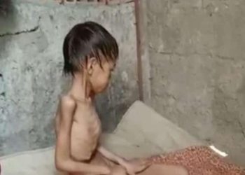Viral, Foto Memprihatinkan Seorang Anak Sangat Kurus di Kota Cilegon