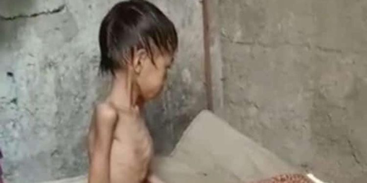 Viral, Foto Memprihatinkan Seorang Anak Sangat Kurus di Kota Cilegon