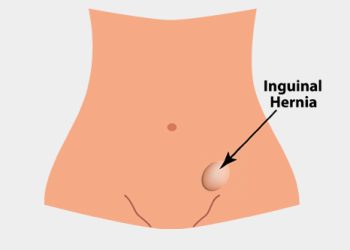 Begini Caranya Atasi Hernia Inguinal Pada Anak Dengan Tepat
