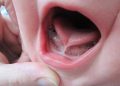 Tongue Tie